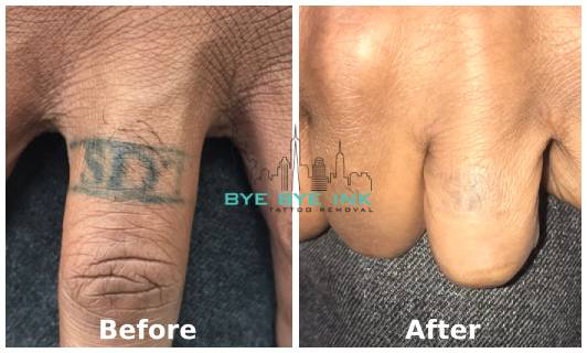 Laser Tattoo Removal NY | Bye Bye Ink | Best Laser - PicoWay