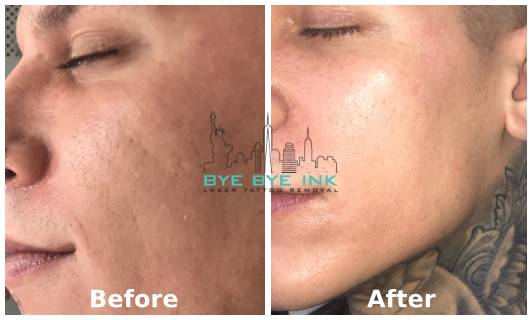 Microneedling tattoo removal before and after